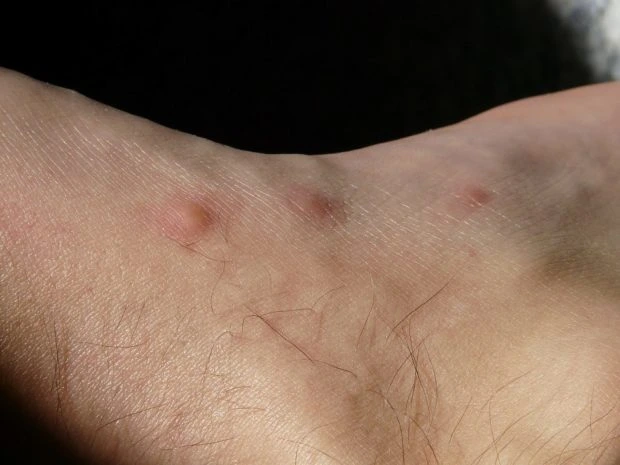Kousnutí štěnice na lidské kůži s několika zarudlými pupínky.