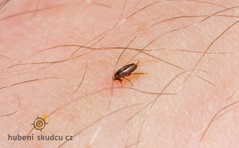 Blecha na lidské kůži mezi vlasy