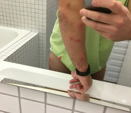 Člověk s kousnutími štěnice na paži v koupelně.